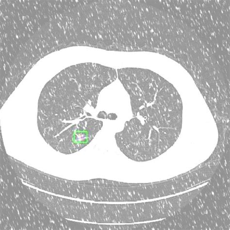 Lung Cancer NormAug Training Instance Segmentation Dataset V1 2023 07