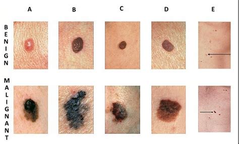 KEEP TRACK OF MOLES ON THE SKIN (MELANOMA) - HEALTH, EXERCISE and DIET