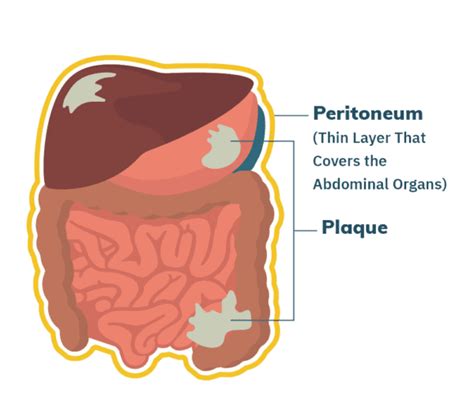 Malignant Peritoneal Mesothelioma > BURSAHAGA.COM