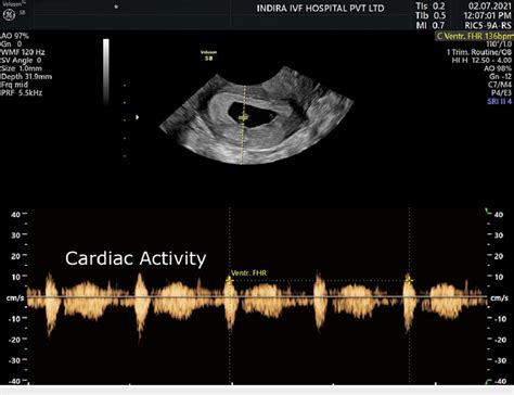 Ultrasound scan with fetal pole and cardiac activity. | Download Scientific Diagram