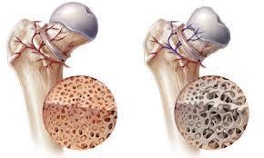 Stem Cells For Avascular Necrosis Avn Of The Femoral Head Hip Dr