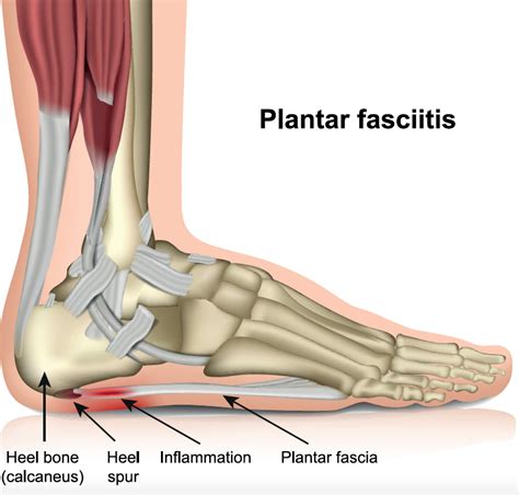 plantar fasciitis pain care clinic