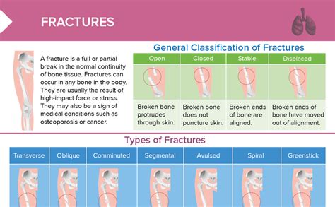 Types Of Fractures Free Cheat Sheet Lecturio Nursing