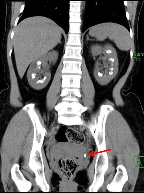 Medullary Nephrocalcinosis Radiology Cases