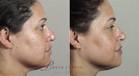 Nonsurgical Face Procedures Before And After Pictures Case 309 Paramus Nj Parker Center For