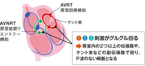 発作性上室頻拍（PSVT）の心電図波形の特徴は？読み方の要点を図解付きで解説！ | エキスパートナースweb