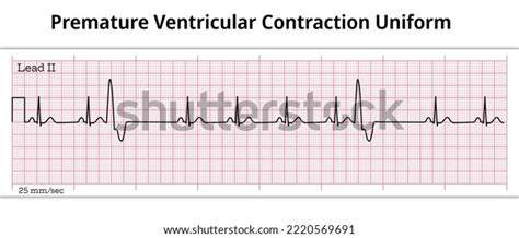 Ecg Premature Ventricular Contraction Uniform Unifocal Stock Vector