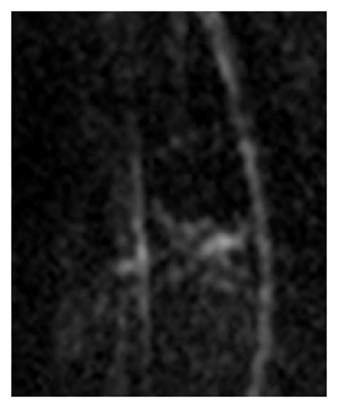 Mri The Bone Metastases Hypointense On T1 Weighted Sagittal Mr Images