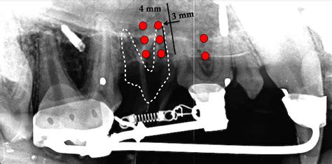 Figure 1 From Effects Of Microosteoperforations On Tooth Movement And