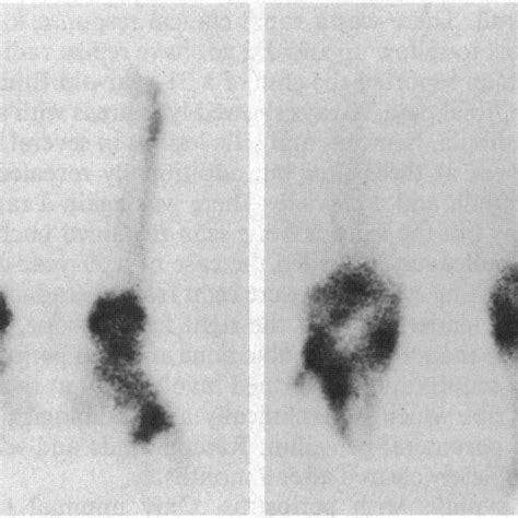 Pdf Periostitis In Secondary Syphilis A Place For Bone Scintigraphy