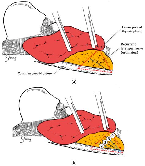 Medicina Free Full Text Comparison Of Recurrent Laryngeal Nerve