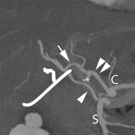 Cta Of The Liver Demonstrating The Proper Hepatic Artery Double