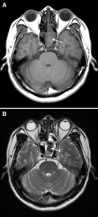 Mri At The Level Of The Sphenoid Sinuses A T1 Weighted Image Showing