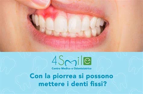 Con La Piorrea O Parodontite Si Possono Mettere I Denti Fissi