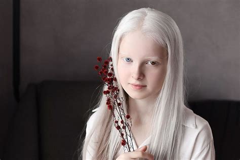 Beautiful People With Albinism