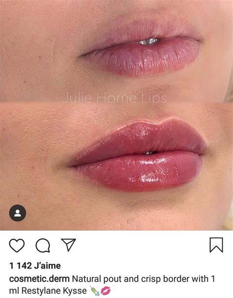 Pin By Kierra Olsen On Lips Botox Lips Lip Fillers Juvederm Lips