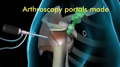 Arthroscopic Bankart Repair Animation YouTube