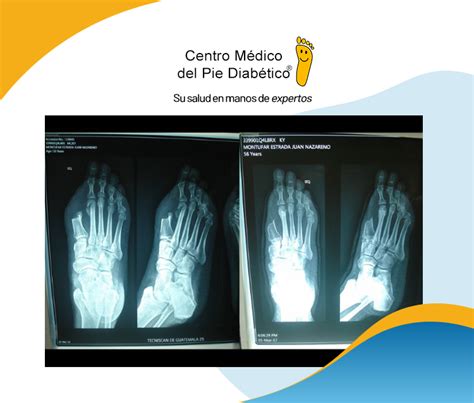 Osteomielitis Centro Médico Del Pie Diabético