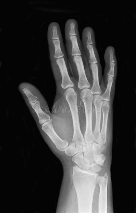 Right Hand X Ray Stock Photo Image Of Office Black 23545536 Photo