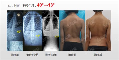 神经肌肉型侧弯矫正实例广东省新苗脊柱侧弯预防中心 脊柱侧弯新苗基金