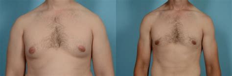 Male Breast Reduction Gynecomastia Before After Photo Gallery