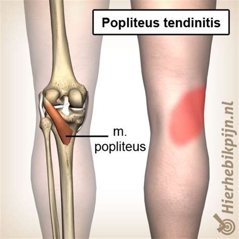 Popliteus Tendinitis