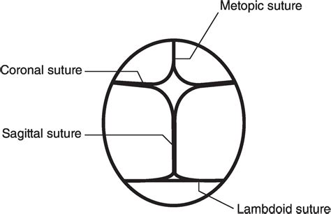 Chapter 40 Craniosynostosis Anesthesia Key