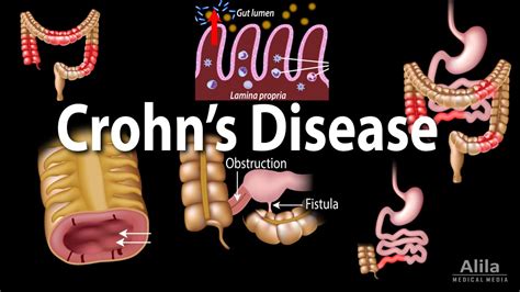 Crohn's Disease Mnemonic