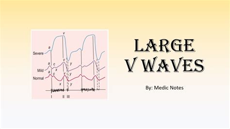 Large V Waves Definition Causes Pathophysiology YouTube