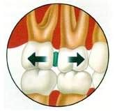 What are Orthodontic Spacers? - Biermann Orthodontics