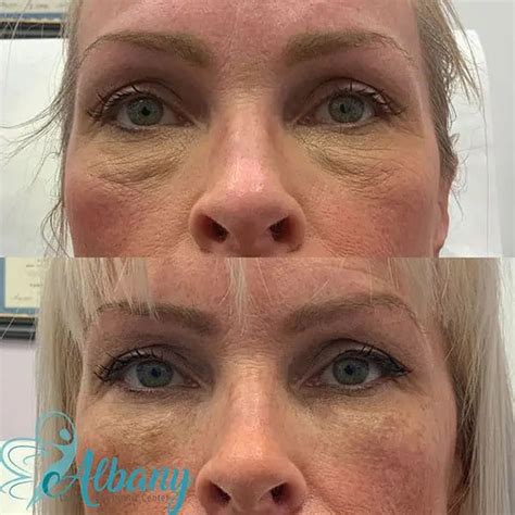 Tear Trough Fillers Case No Albany Cosmetic And Laser Centre In