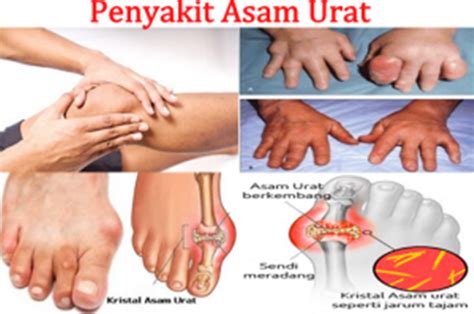 Asam Urat Nama Medis Homecare24