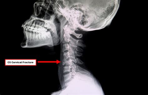 how to know if your neck is broken
