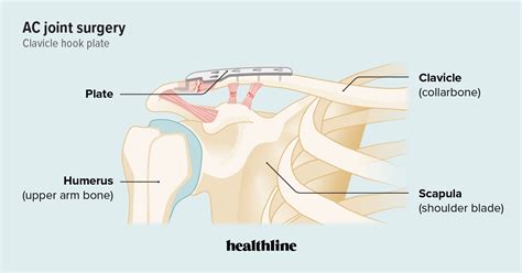 AC Joint Surgery: Types, Costs, and Recovery