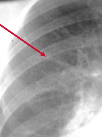 Cephalization on chest x-ray - wikidoc