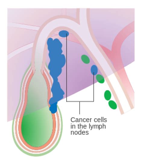 How Do Cancer Cells Spread Cancer Cells Growth Mode Of Spread