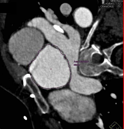 Bicuspid Aortic Valve With Dilated Ascending Aorta With Vascular