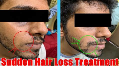 Sudden Patchy Hair Loss Alopecia Areata Treatment By Intralesional Steroid Injection Youtube