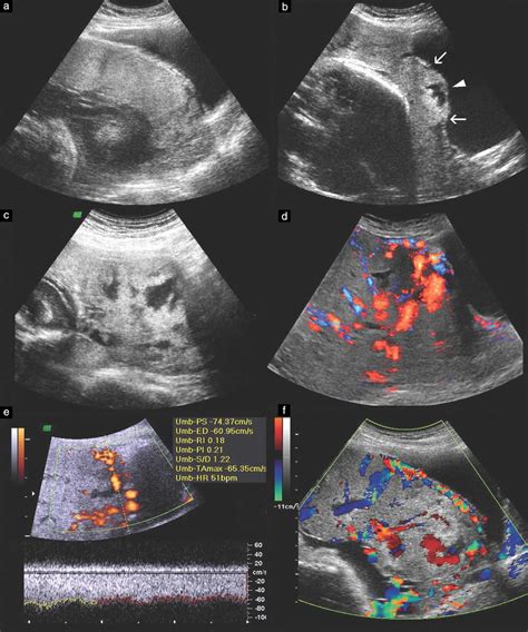 Placenta Accreta Ultrasound