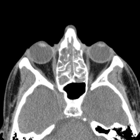 Double Density Sign In Fungal Sinusitis Double Density Sign In Fungal