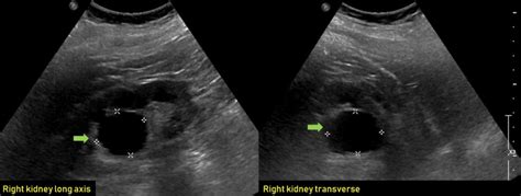 Renal Cyst Ultrasound