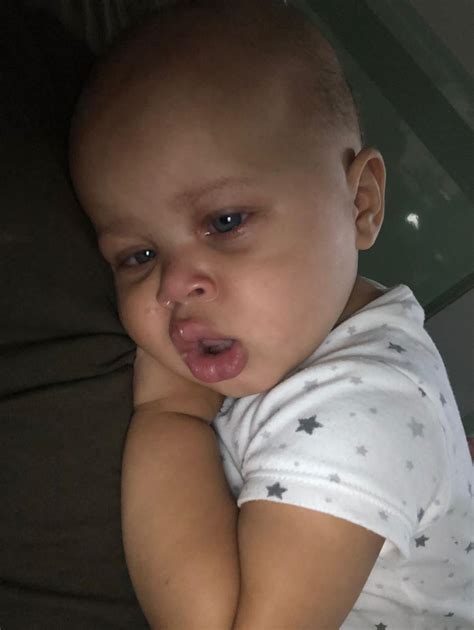 Doctors misdiagnosed baby's cancer as eczema, she lost an eye