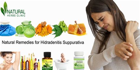 Natural Remedies for Hidradenitis Suppurativa - Dubai Entertainment