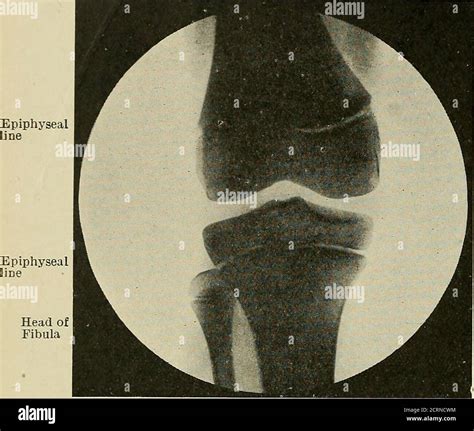 Tibial Fracture Banque De Photographies Et Dimages Haute R Solution