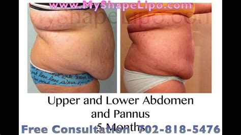 Large Volume Liposuction Before And After See Dramatic Results Youtube