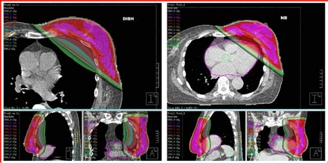 Dosimetrical Comparison Between Plans In Dibh And Nb Download
