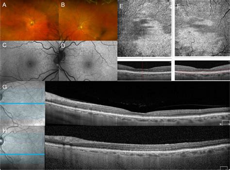 Autoimmune Retinopathy Associated With Systemic Autoimmune Disease A