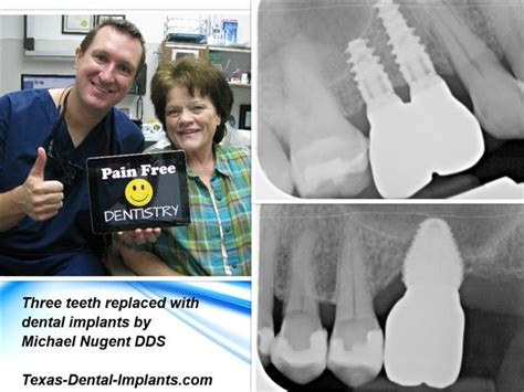 Extract Tooth Place Implant The Pasadena Dentist Michael Nugent Dds