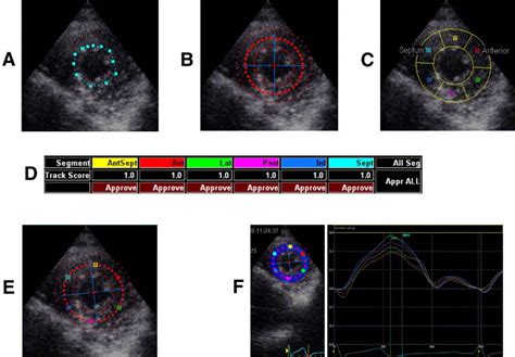 Age Related Changes In Left Ventricular Twist Assessed By Two