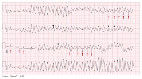 Analysis of the 12-lead ECG. Wide complex rhythm showing normal QRS ...